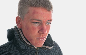 anaphylaxis course